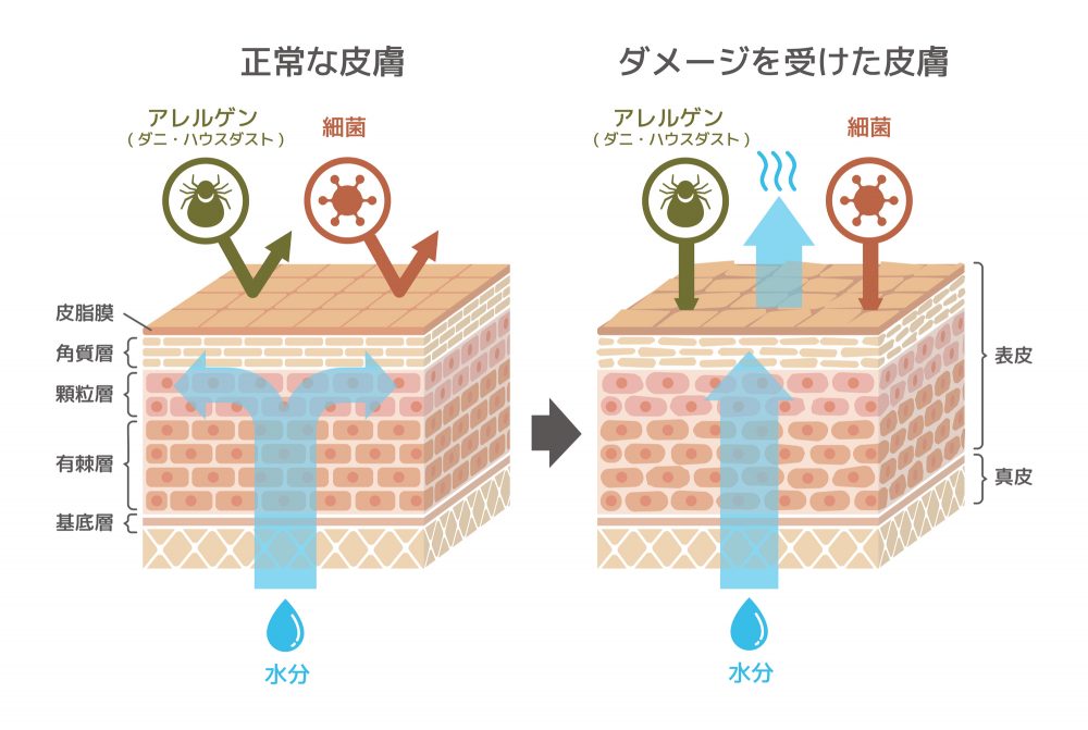 アトピー性皮膚炎｜名取つちやま皮ふ科